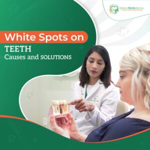 The Truth Behind White Spots on Teeth: Causes and Solutions 