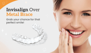 Invisalign